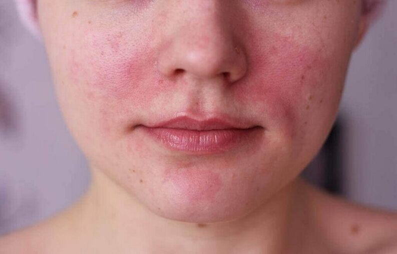 Masalah kulit sebagai tanda kehadiran parasit di dalam badan